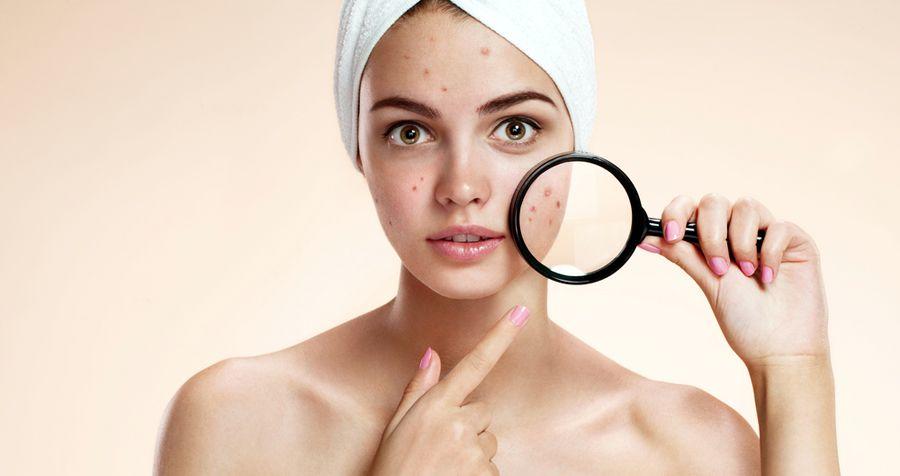 Acne 12 Solutions Naturelles Et Recettes Pour S En Debarrasser Mieux Vivre Autrement